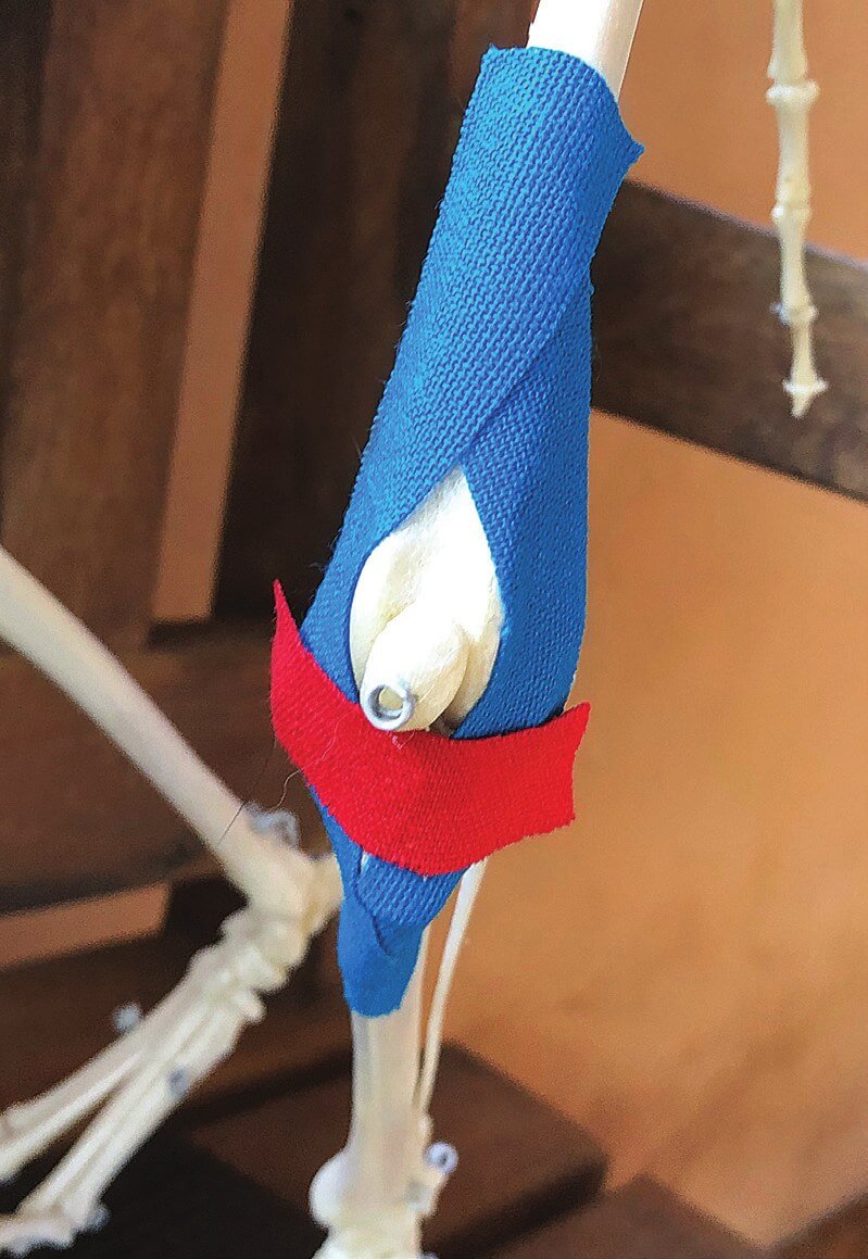 I-strips applied on the medial side for extra patellar support