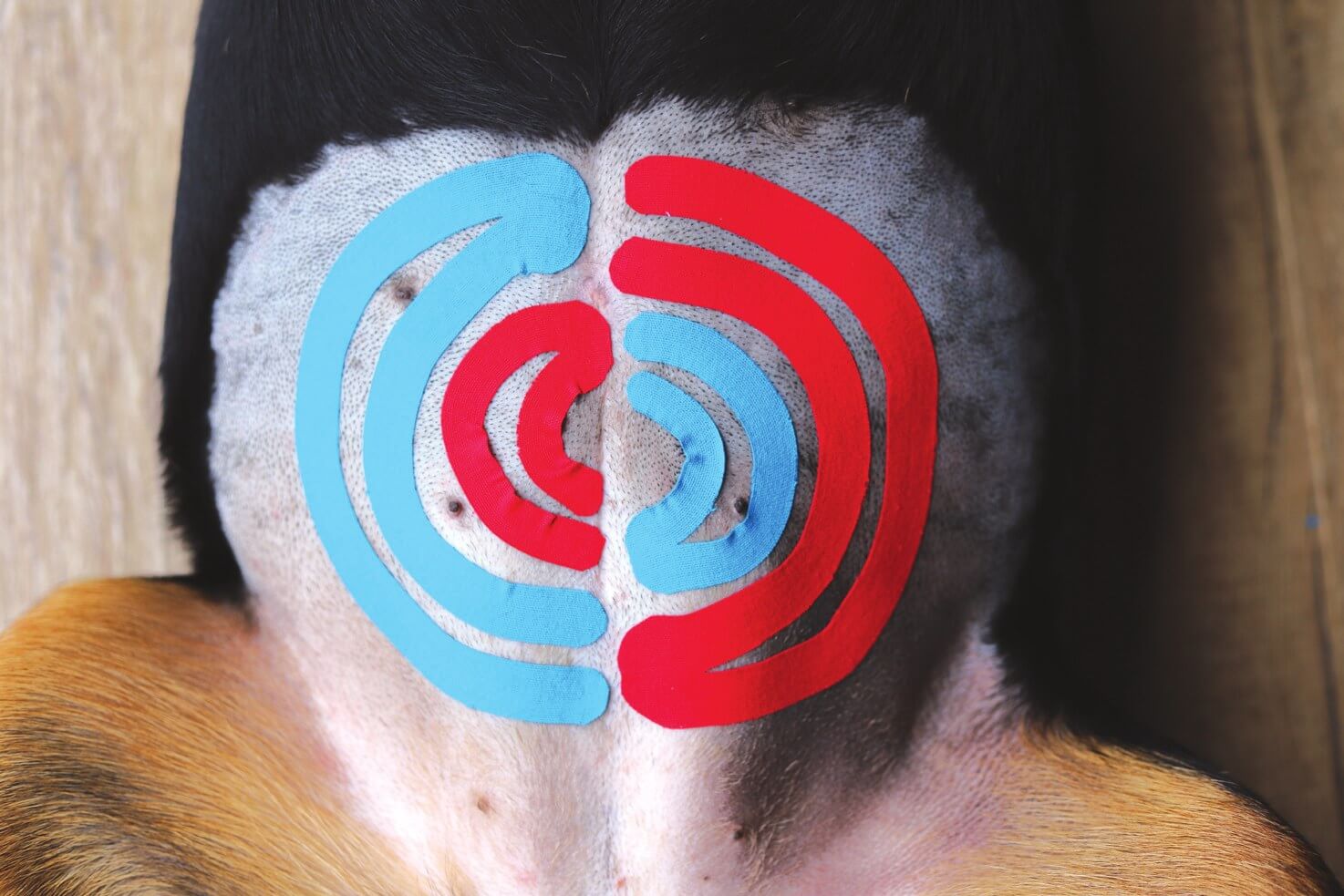 Spiraltechnik mit mehreren Y-förmigen Kinesio-Tape-Schnitten